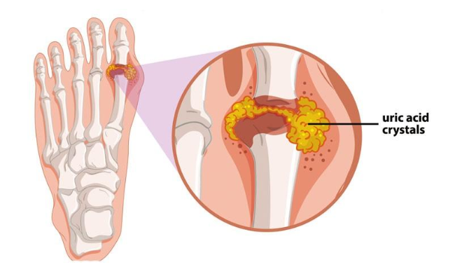 Gout là quá trình lắng đọng tinh thể urat ở các khớp xương.
